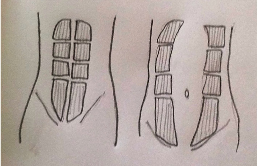 The rectus abdominis muscles (‘6 pack’) which run in two parallel lines up your, tummy stretch and lengthen during pregnancy. Rectus abdominis separation (or diastase recti) occurs as the two bands of muscle which used to lie parallel stretch away form the midline to make more space for the growing uterus.