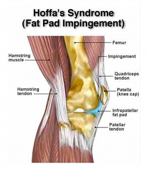 Patellofemoral Pain Syndrome in Runners: Movement Dysfunctions