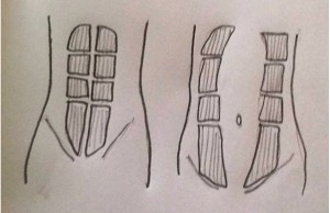 The rectus abdominis muscles (‘6 pack’) which run in two parallel lines up your, tummy stretch and lengthen during pregnancy. Rectus abdominis separation (or diastase recti) occurs as the two bands of muscle which used to lie parallel stretch away form the midline to make more space for the growing uterus.