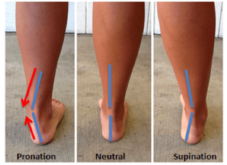 What is Overpronation?