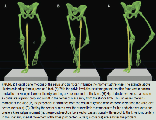 Unilateral Loading Biomechanics Patellofemoral Pain Syndrome - Unilateral Loading Biomechanics