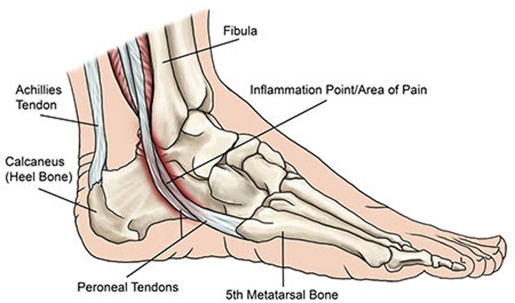 Running with Peroneal Tendonitis