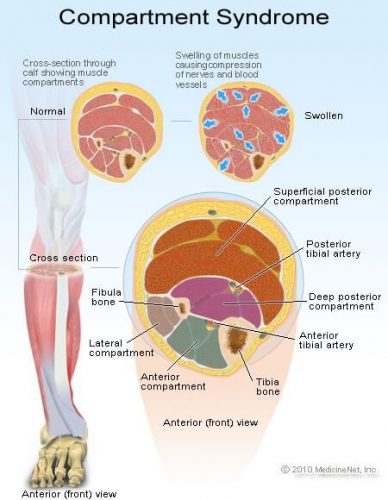 Can You Run with Anterior Compartment Syndrome?