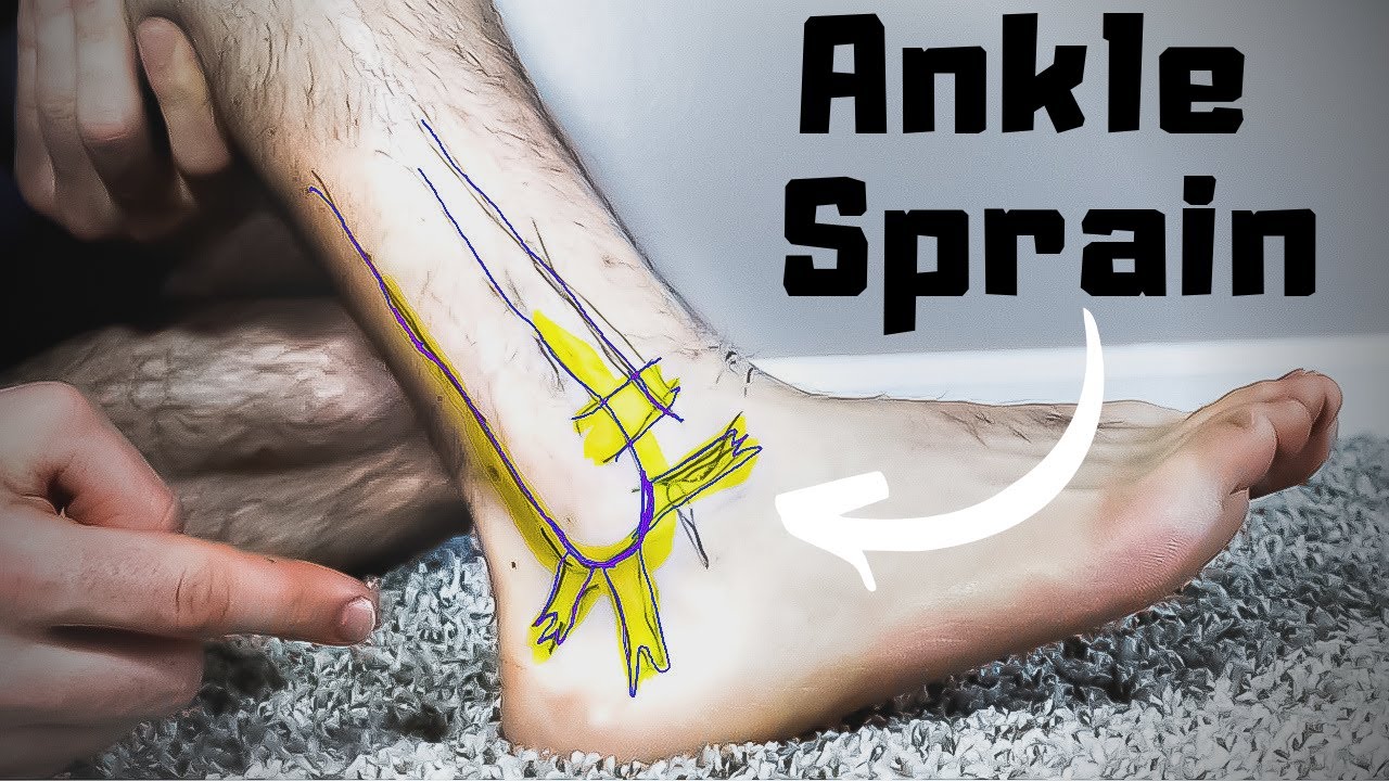 Ankle Sprain Treatment, Symptoms, and Prevention - Dr. Mikkel Jarman